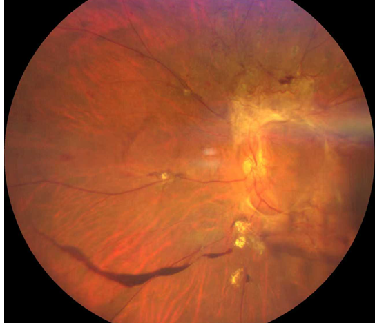 糖尿病視網(wǎng)膜病變