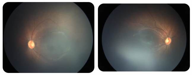 早產(chǎn)兒視網(wǎng)膜病變